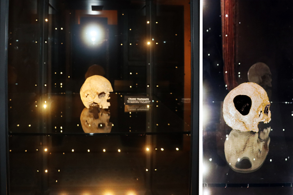 Cranio trapanato di uomo dell'età del bronzo